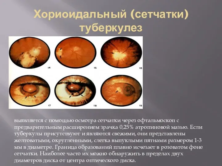 Хориоидальный (сетчатки) туберкулез выявляется с помощью осмотра сетчатки через офтальмоскоп