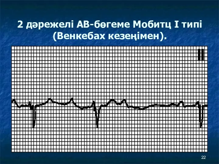 2 дәрежелі АВ-бөгеме Мобитц I типі (Венкебах кезеңімен).