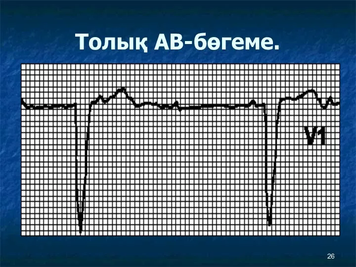 Толық АВ-бөгеме.