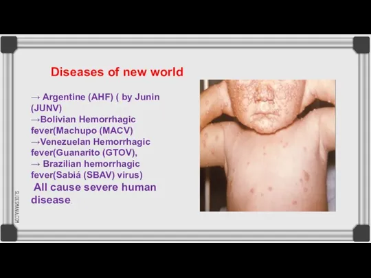 → Argentine (AHF) ( by Junin (JUNV) →Bolivian Hemorrhagic fever(Machupo