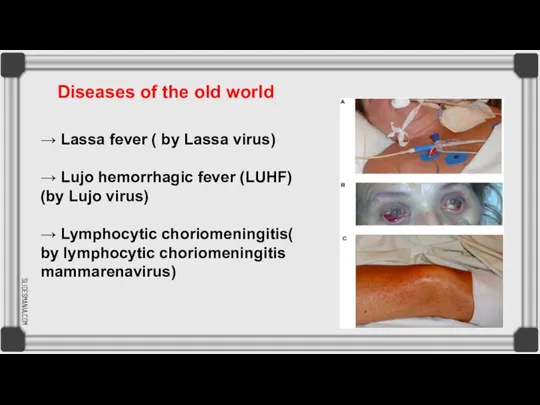 Diseases of the old world → Lassa fever ( by