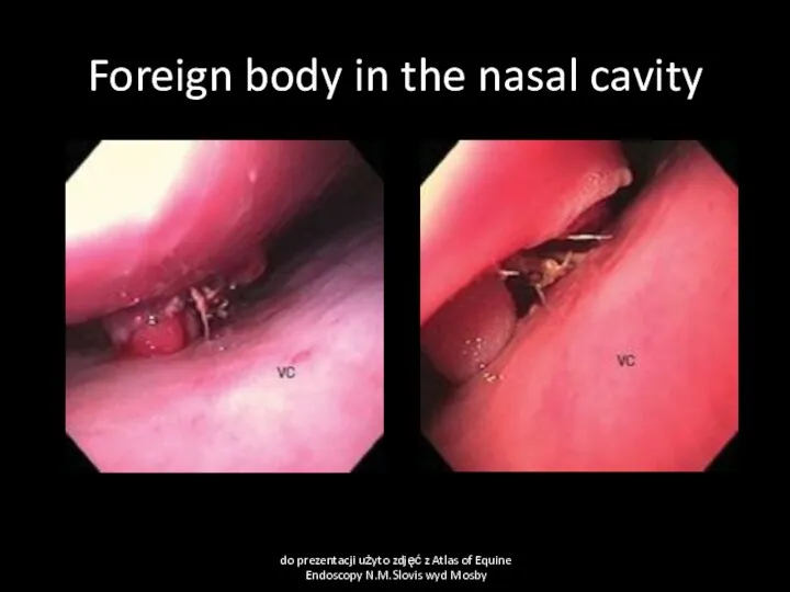 Foreign body in the nasal cavity do prezentacji użyto zdjęć