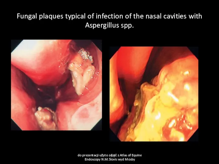 Fungal plaques typical of infection of the nasal cavities with