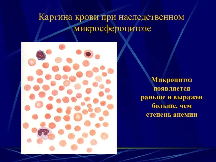 Картина крови при наследственном микросфероцитозе Микроцитоз появляется раньше и выражен больше, чем степень анемии