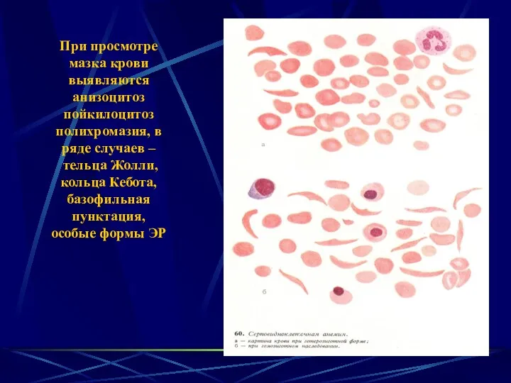 При просмотре мазка крови выявляются анизоцитоз пойкилоцитоз полихромазия, в ряде