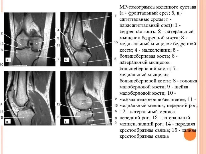 МР-томограмма коленного сустава (а - фронтальный срез; б, в -