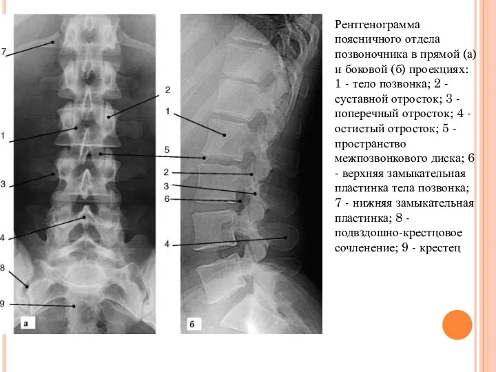 Рентгенограмма поясничного отдела позвоночника в прямой (а) и боковой (б)