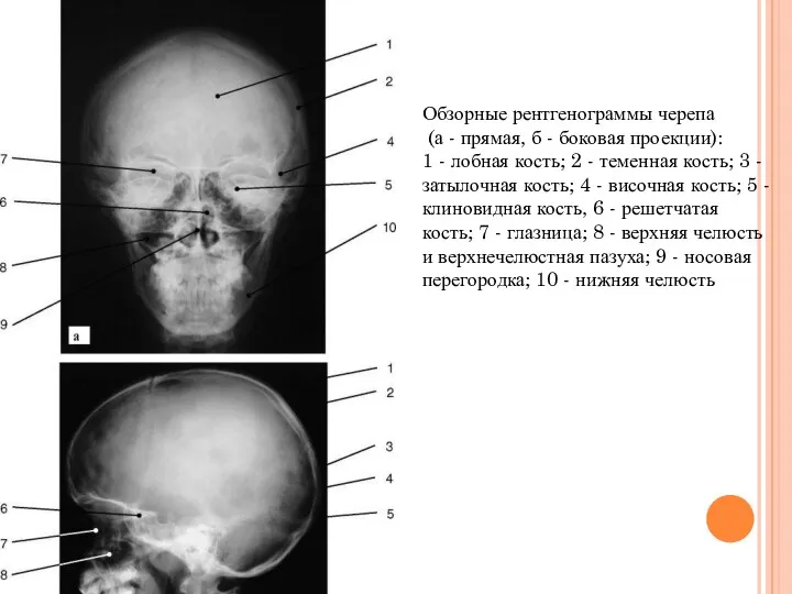 Обзорные рентгенограммы черепа (а - прямая, б - боковая проекции):