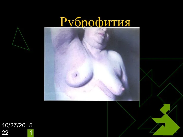 10/27/2022 Руброфития