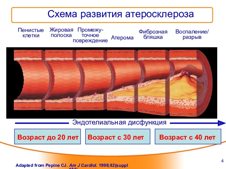Схема развития атеросклероза Пенистые клетки Жировая полоска Промежу- точное повреждение Атерома Фиброзная бляшка