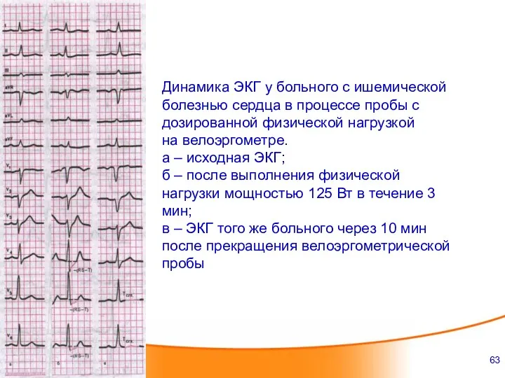 Динамика ЭКГ у больного с ишемической болезнью сердца в процессе пробы с дозированной