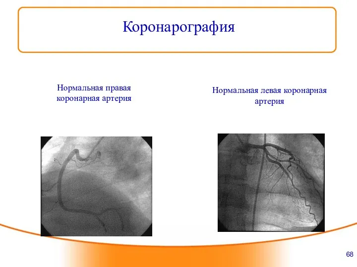 Нормальная левая коронарная артерия Нормальная правая коронарная артерия Коронарография