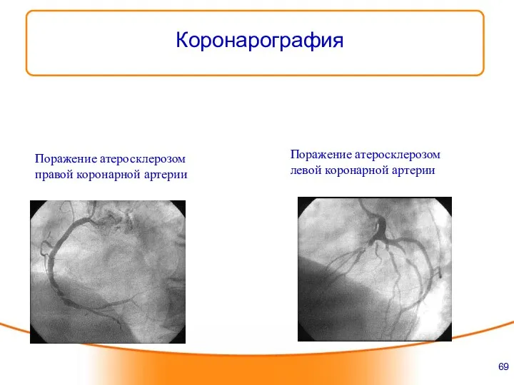 Коронарография Поражение атеросклерозом левой коронарной артерии Поражение атеросклерозом правой коронарной артерии