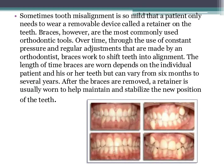 Sometimes tooth misalignment is so mild that a patient only