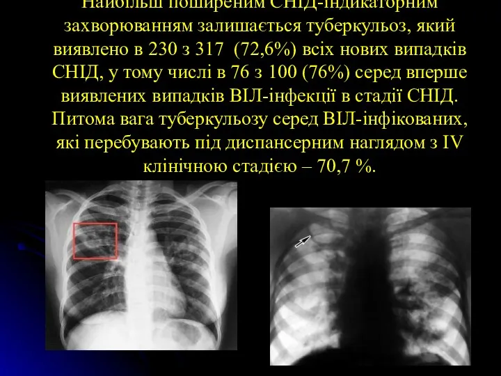 Найбільш поширеним СНІД-індикаторним захворюванням залишається туберкульоз, який виявлено в 230