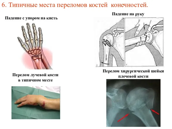 6. Типичные места переломов костей конечностей. Перелом лучевой кости в типичном месте Перелом