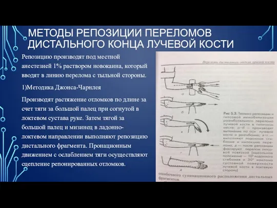 МЕТОДЫ РЕПОЗИЦИИ ПЕРЕЛОМОВ ДИСТАЛЬНОГО КОНЦА ЛУЧЕВОЙ КОСТИ Репозицию производят под