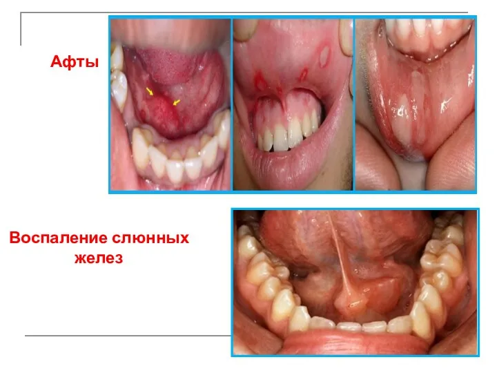 Афты Воспаление слюнных желез