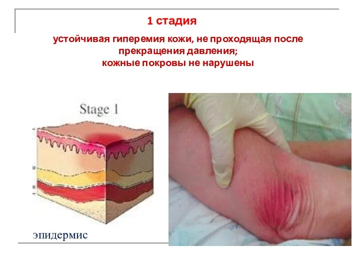 устойчивая гиперемия кожи, не проходящая после прекращения давления; кожные покровы не нарушены 1 стадия эпидермис