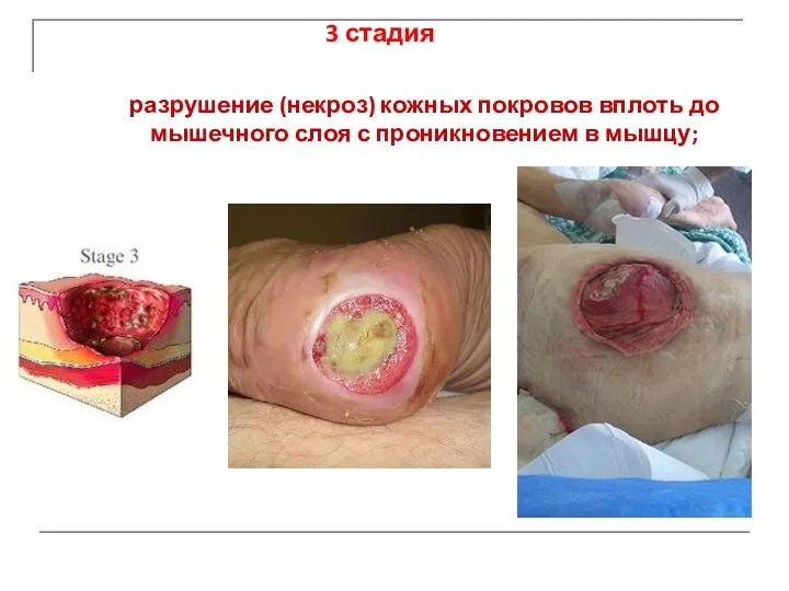 разрушение (некроз) кожных покровов вплоть до мышечного слоя с проникновением в мышцу; 3 стадия