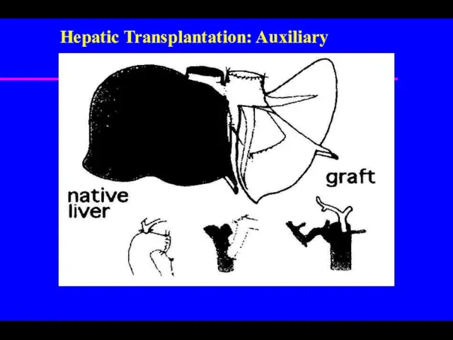 Hepatic Transplantation: Auxiliary