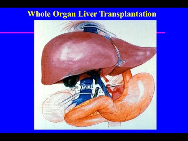 Whole Organ Liver Transplantation