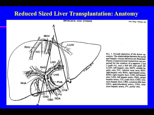 Reduced Sized Liver Transplantation: Anatomy