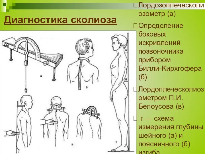 Диагностика сколиоза Лордозоплеческолиозометр (а) Определение боковых искривлений позвоночника прибором Билли-Kирхгофера (б) Лордоплеческолиозометром П.И.