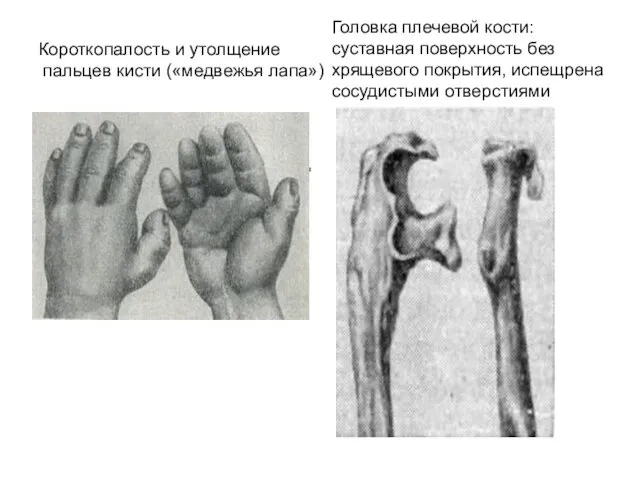 Короткопалость и утолщение пальцев кисти («медвежья лапа») Головка плечевой кости: суставная поверхность без