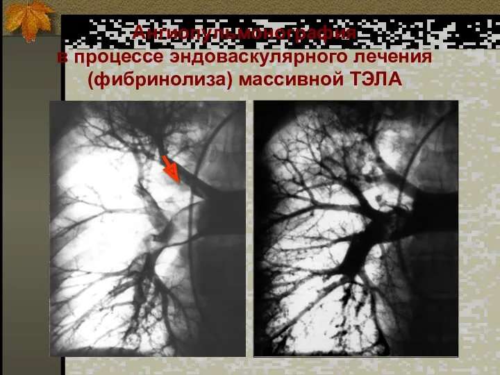 Ангиопульмонография в процессе эндоваскулярного лечения (фибринолиза) массивной ТЭЛА