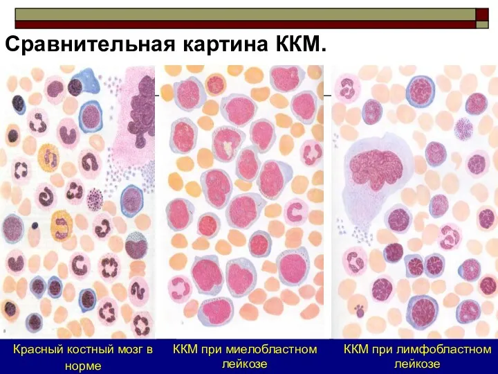 Красный костный мозг в норме ККМ при лимфобластном лейкозе ККМ при миелобластном лейкозе Сравнительная картина ККМ.