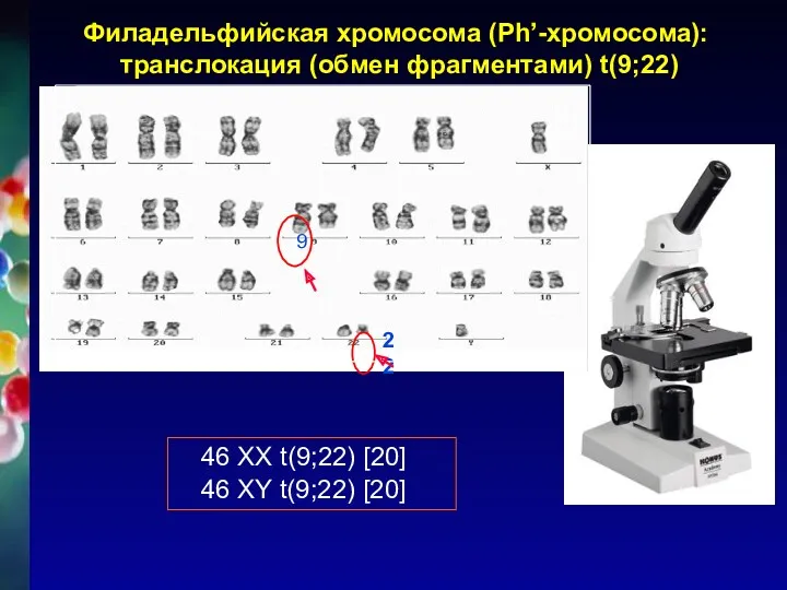 Филадельфийская хромосома (Ph’-хромосома): транслокация (обмен фрагментами) t(9;22)