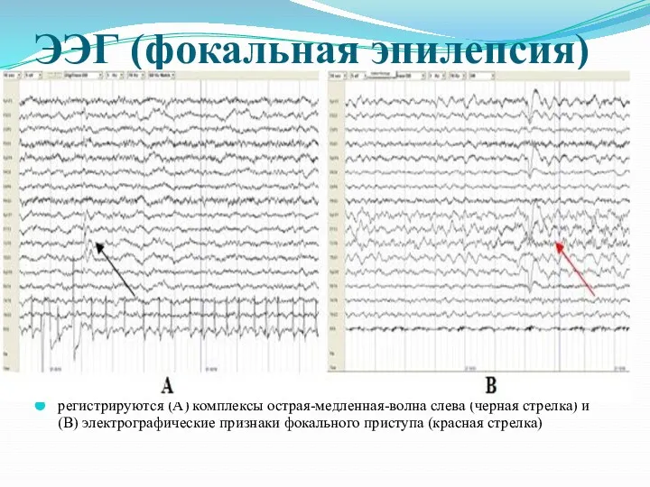 ЭЭГ (фокальная эпилепсия) регистрируются (A) комплексы острая-медленная-волна слева (черная стрелка)