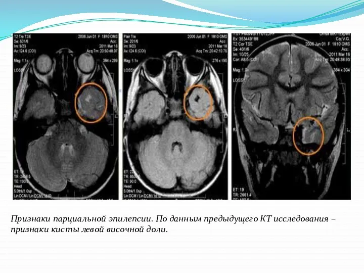 Признаки парциальной эпилепсии. По данным предыдущего КТ исследования – признаки кисты левой височной доли.