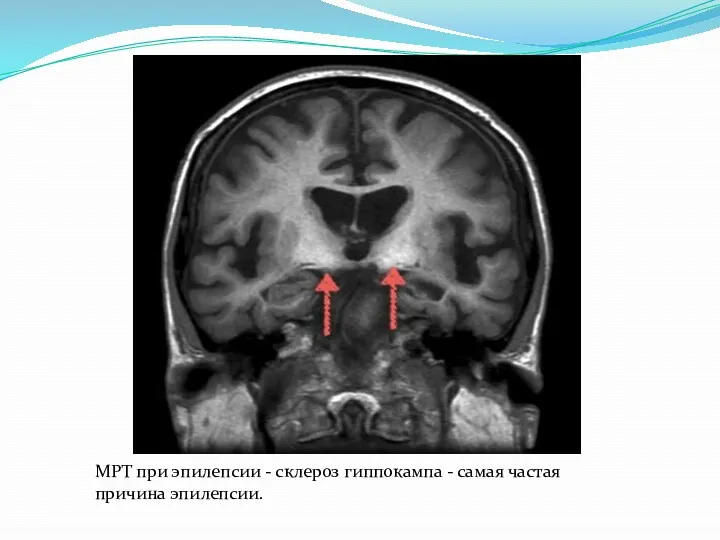 МРТ при эпилепсии - склероз гиппокампа - самая частая причина эпилепсии.