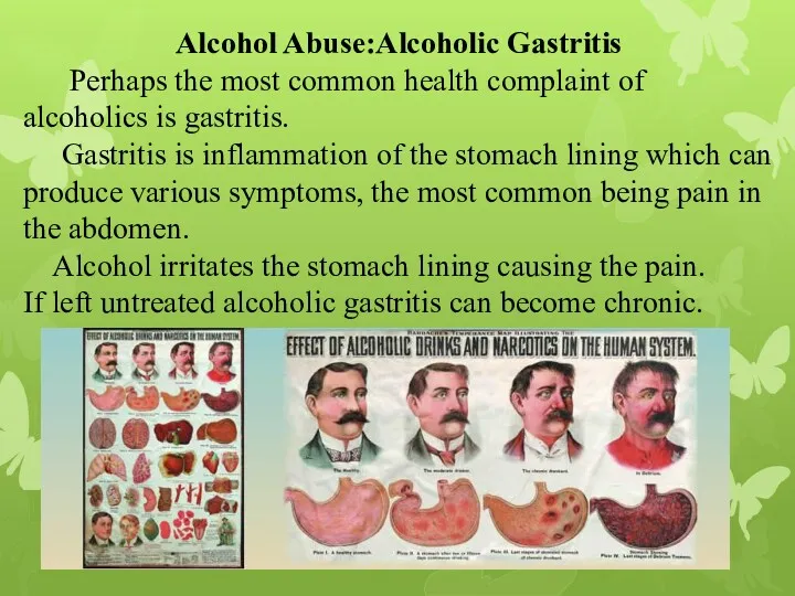 Alcohol Abuse:Alcoholic Gastritis Perhaps the most common health complaint of