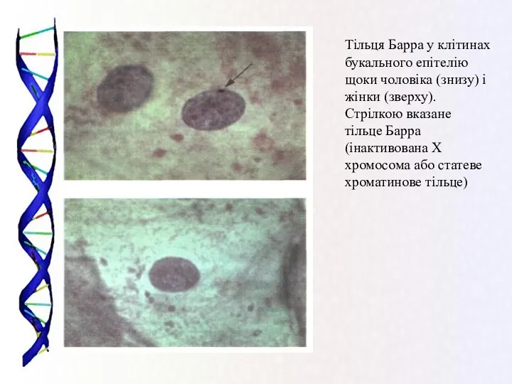 Тільця Барра у клітинах букального епітелію щоки чоловіка (знизу) і