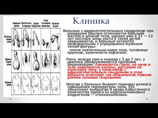 Клиника Больные с адреногенитальным синдромом при рождении обычно отличаются большой