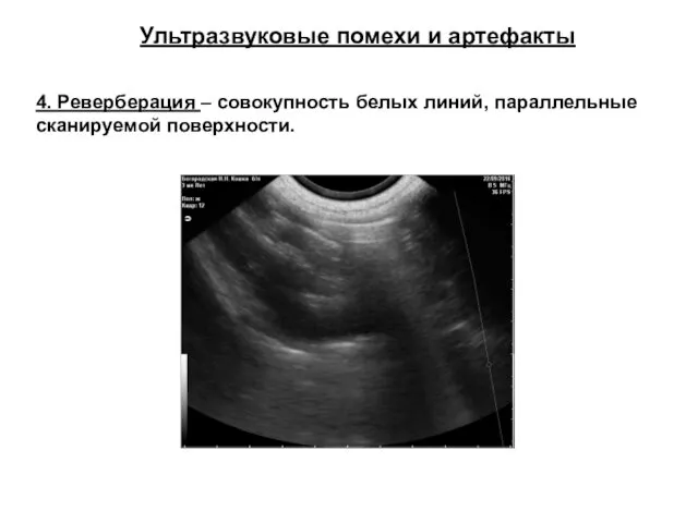 Ультразвуковые помехи и артефакты 4. Реверберация – совокупность белых линий, параллельные сканируемой поверхности.