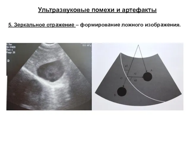 Ультразвуковые помехи и артефакты 5. Зеркальное отражение – формирование ложного изображения.