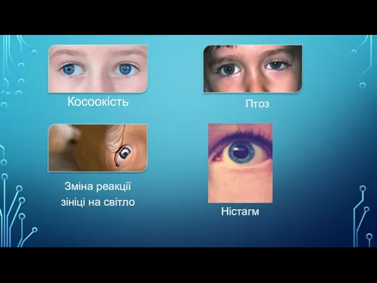 Косоокість Зміна реакції зініці на світло Ністагм Птоз