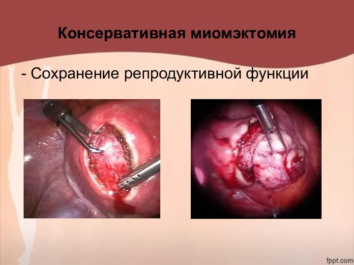 Консервативная миомэктомия - Сохранение репродуктивной функции