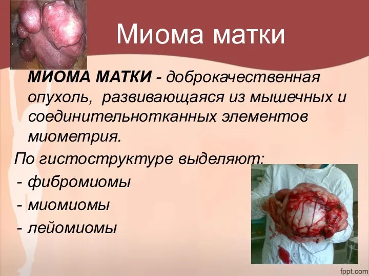 Миома матки МИОМА МАТКИ - доброкачественная опухоль, развивающаяся из мышечных и соединительнотканных элементов