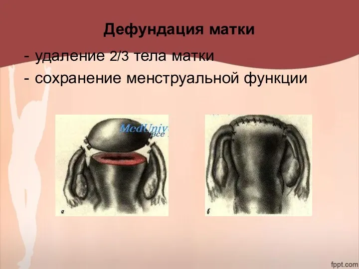 Дефундация матки удаление 2/3 тела матки сохранение менструальной функции