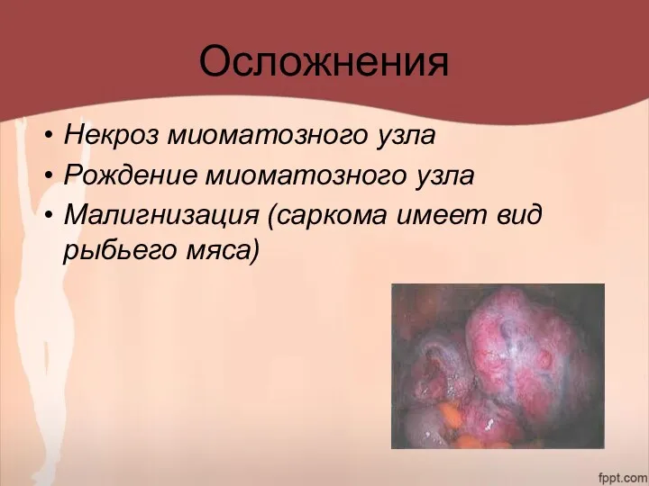 Осложнения Некроз миоматозного узла Рождение миоматозного узла Малигнизация (саркома имеет вид рыбьего мяса)