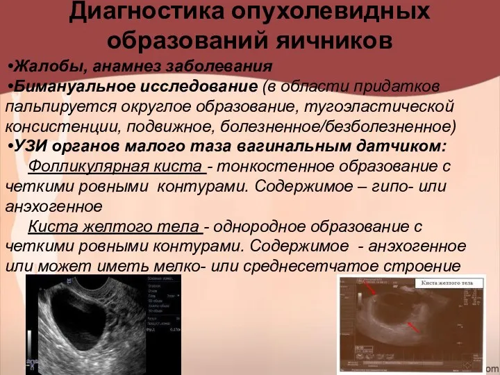 Диагностика опухолевидных образований яичников Жалобы, анамнез заболевания Бимануальное исследование (в области придатков пальпируется