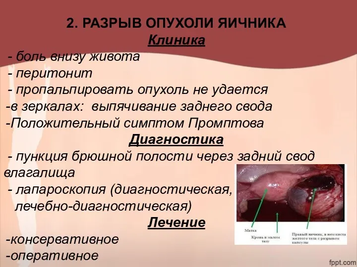 2. РАЗРЫВ ОПУХОЛИ ЯИЧНИКА Клиника - боль внизу живота -