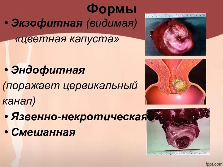 Формы Экзофитная (видимая) «цветная капуста» Эндофитная (поражает цервикальный канал) Язвенно-некротическая Смешанная