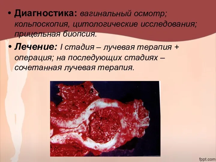 Диагностика: вагинальный осмотр; кольпоскопия, цитологические исследования; прицельная биопсия. Лечение: I стадия – лучевая