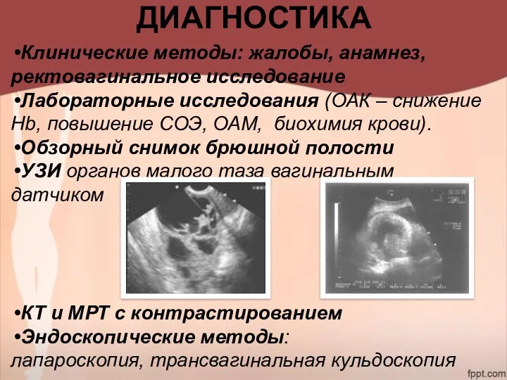 ДИАГНОСТИКА Клинические методы: жалобы, анамнез, ректовагинальное исследование Лабораторные исследования (ОАК – снижение Hb,